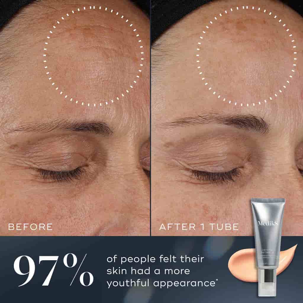 Before and after comparison of skin treatment with a tube of cream displayed.